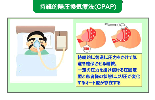 持続的陽圧換気療法(CPAP)